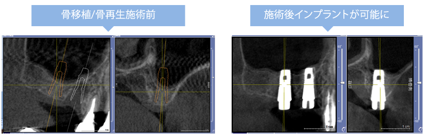 骨移植/骨再生のCT画像