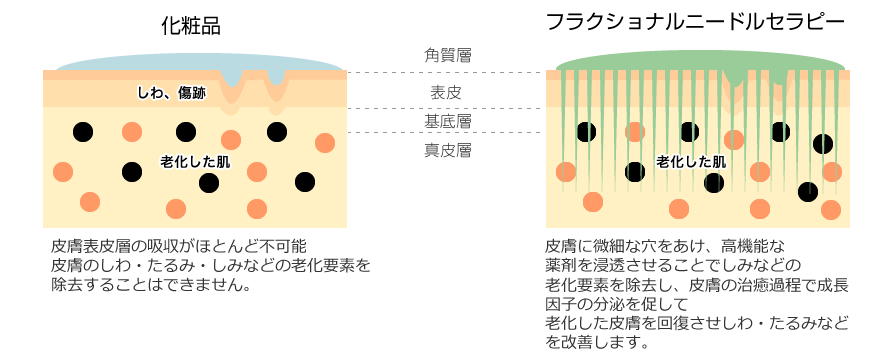 フラクショナルニードルセラピーは皮膚に微細な穴をあけ、高機能な薬剤を浸透させることでしみなどの老化要素を除去し、皮膚の治癒過程で成長因子の分泌を促して老化した皮膚を回復させしわ・たるみなどを改善します。