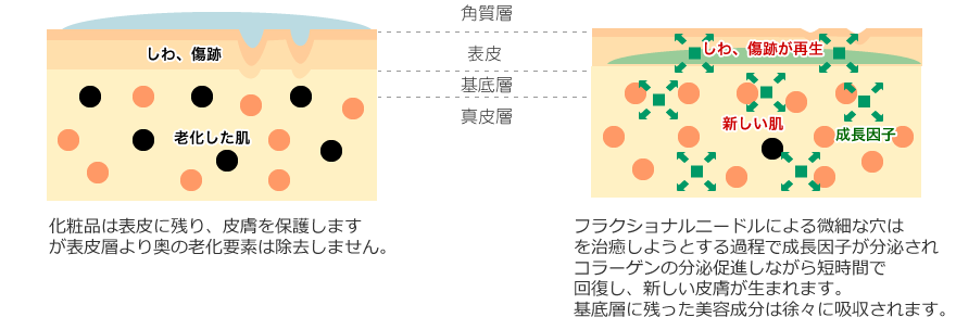 化粧品は表皮に残り、皮膚を保護しますが表皮層より奥の老化要素は除去しません。