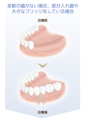 逗子・鎌倉・葉山のインプラント治療の適用例2｜多数の歯がない場合、部分入れ歯や大きなブリッジをしている場合 