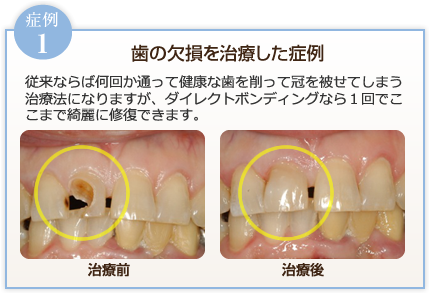 歯の欠損を治療した症例