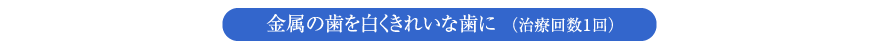 金属の歯を白くきれいな歯に